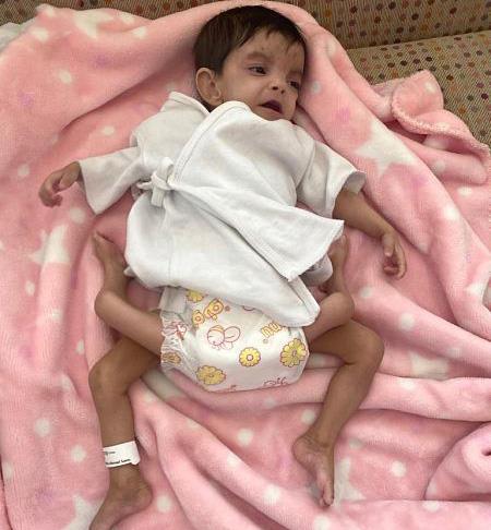 السعودية تنجح في فصل التوأم الطفيلي اليمني "توأم عائشة"