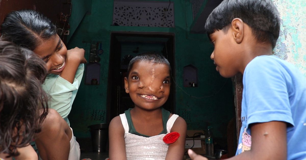شاهد: صغيرة في الهند لها أنفين تتحول لآلهة يقدسها الأهالي