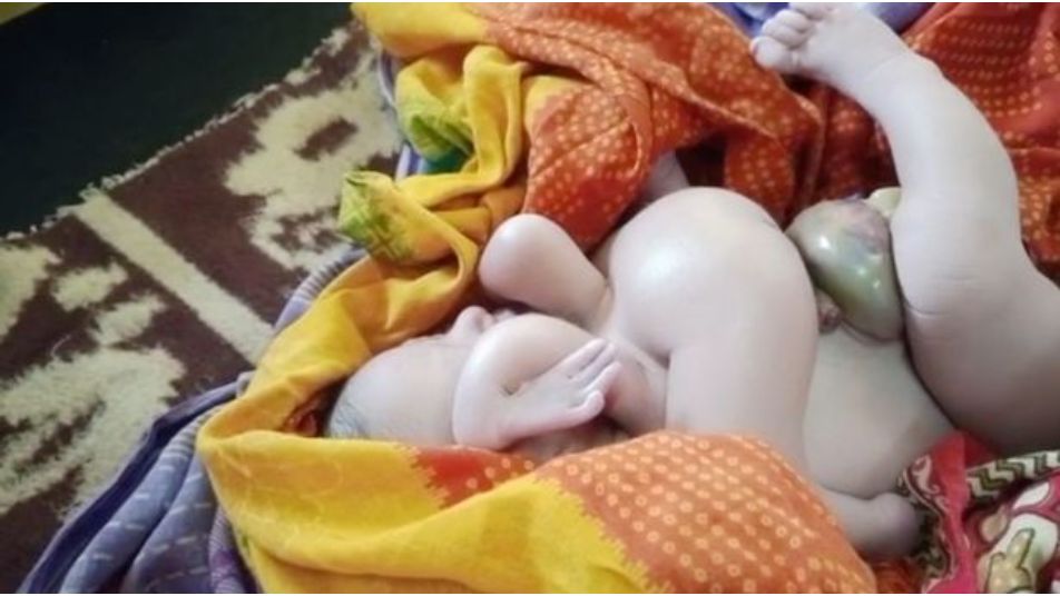 شاهد: حالة ولادة نادرة وغريبة.. المولود له 4 أرجل و4 أيدٍ في الهند واتخذه الأهالي مرسال الإله