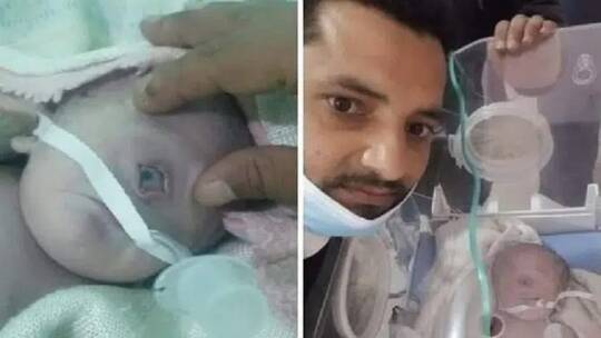 ولادة طفل عربي بعين واحدة