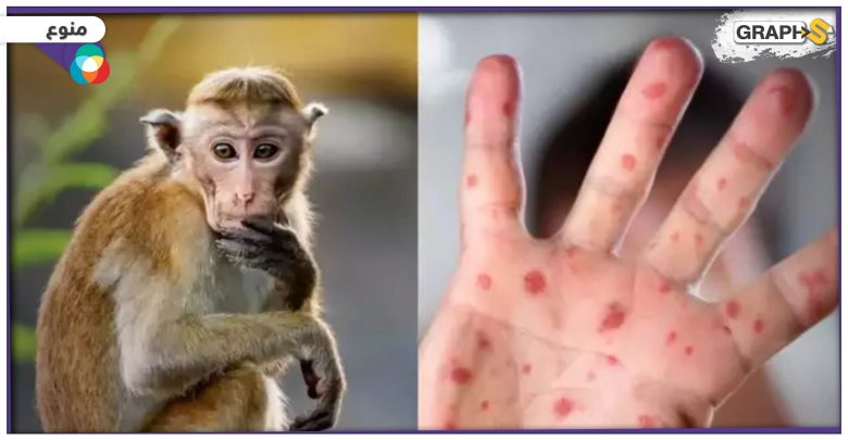 بعد المغرب تسجيل أول إصابة بجدري القردة في لبنان