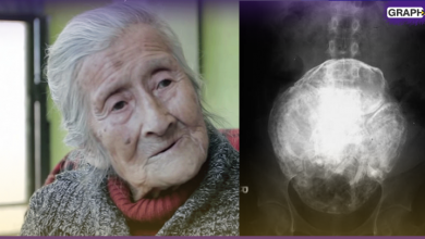 قصة سيدة تبلغ من العمر 92 عاماً حملت جنيناً بداخلها لمدة 50 عام